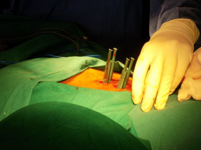 Minimally-Invasive-Spine-Surgery