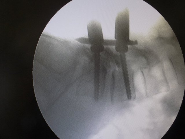 Minimally-Invasive-Spine-Surgery