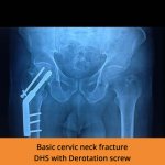 Cervic Neck fracture ortho treatment erode