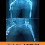 Bone Fracture Hospitals in erode