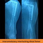 Fracture Ortho Treatment in erode