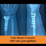 Plating Ortho Treatment - TPN Hospitals Erode