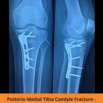 Tibia Ortho Treatment  - TPN Hospitals Erode