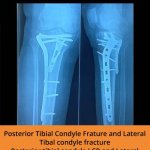 Tibia Ortho Treatment - TPN Hospitals Erode