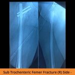 Fracture Ortho Treatment - TPN Hospitals Erode