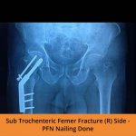 Sub Trochenteric Ortho treatment - TPN Hospitals Erode