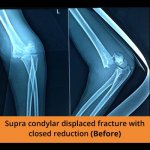 Supra Condylar Fracture - TPN Hospitals Erode