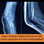 Supra Condylar Fracture - TPN Hospitals Erode