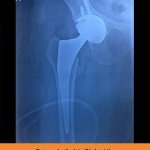 Total Hip Replacement - TPN Hospitals Erode