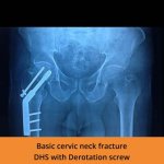 Bone Fracture Treatment - TPN Hospitals Erode