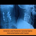 anterior-and-posterior-cervical-spine-spine-hospitals