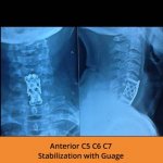 anterior-c5-c6-c7-stabilization-spine-hospitals