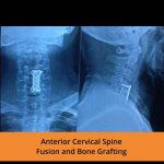 anterior-cervical-spine-fusion-and-bone-grafting-tpn-hospitals