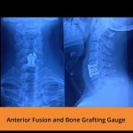 anterior-fusion-and-bone-grafting-gauge-tpn-spine-hospitals-