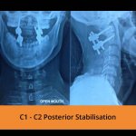 c1-c2-posterior-stabilisation-spine-surgeon