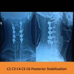 c2-c3-c4-c5-c6-posterior-stabilization-spine-hospitals