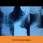 c3-c4-cervical-spine-tpn-hospitals-spine