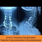 c3-to-c7-posterior-cervical-spine-tpn-hospitals