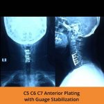 c5-c6-c7-anterior-stabilization-tpn-hospitals-spine