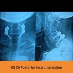 c5-c6-posterior-instrumentation-tpn-hospitals