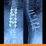 d10-to-l3-posterior-stabilization-tpn-hospitals-spine