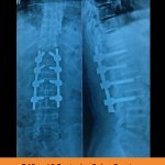 d12-to-l3-posterior-spine-fracture-posterior-tpn-hospitals-spine