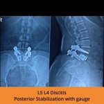 l5-l4-discitis-posterior-stabilization-with-gauge-spine-surgeon