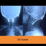 oc-fusion-spine-treatment-tpn-hospitals