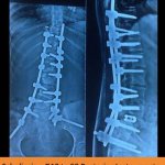 scholiasis-d10-s2-posterior-spine-hospitals