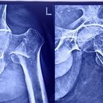 Subtrochanteric Fractures