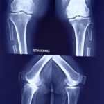 Proximal fibula Osteotomy