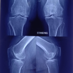 Proximal fibula Osteotomy-Before