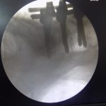 angelo spondylolisthesis 13