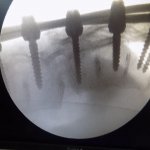 angelo spondylolisthesis 5