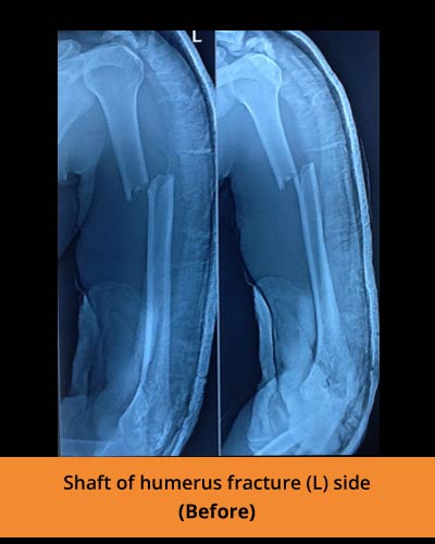 ORIF-plating-(Ortho-hospital).JPG