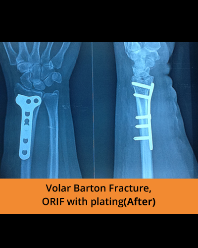 ORIF-with-plating-(Ortho-hospital).JPG