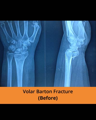 Volar-barton-fracture-(Ortho-hospital).JPG