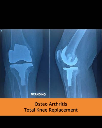 Ortho Surgery and Treatments in erode | Bone Fractures, Joint, Knee ...