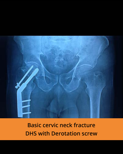 Basic-cervic-neck-fracture-(TPN-hospital)