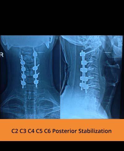 Best spine hospital in erode- TPN hospital