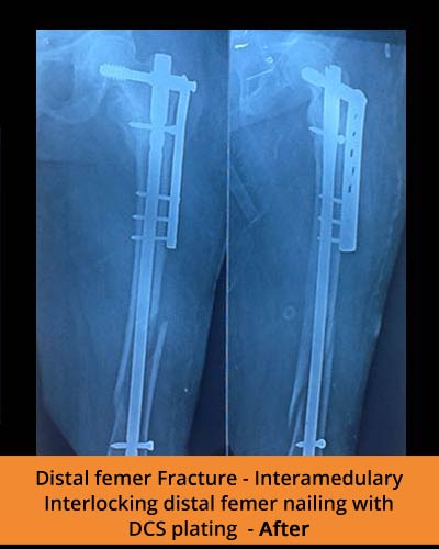 Distal-Femer-Fracture-(TPN-hospital)