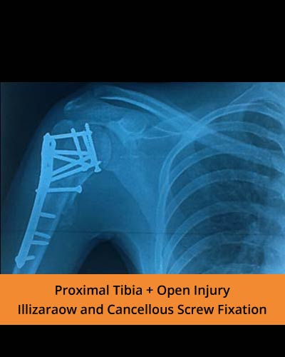 Top Orthopedic hospital in erode