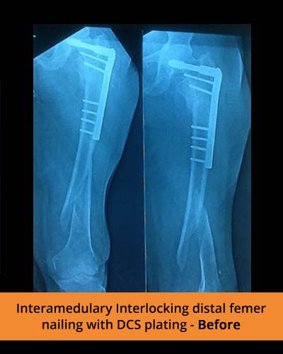 Interamedulary-Interlocking-distal-plating-Before-(Ortho-hospital)