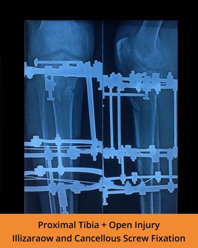 Top Orthopaedics Hospital in Erode